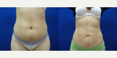 Liposuction before and after photo