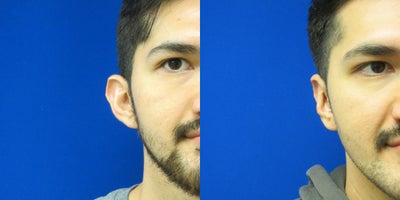 before and after image