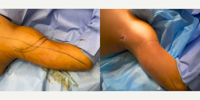 Liposuction before and after photo