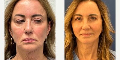 Neck Lift before and after photo