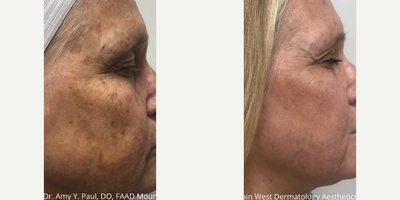 Skin Rejuvenation before and after photo