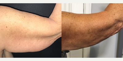 Arm Lift before and after photo
