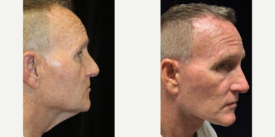 Deep Plane Facelift before and after photo