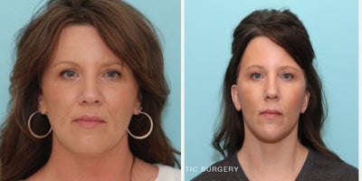 Facelift before and after photo