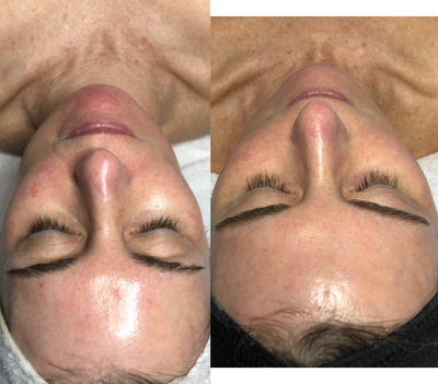 Facial before and after photo