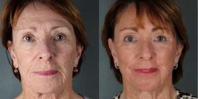Laser Resurfacing before and after photo