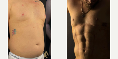 Abdominal Etching before and after photo