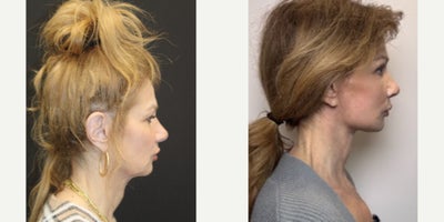 Brow Lift before and after photo
