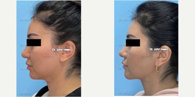 Buccal Fat Removal before and after photo