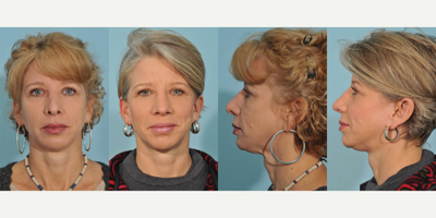 Facelift before and after photo