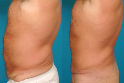 Male Tummy Tuck before and after photo