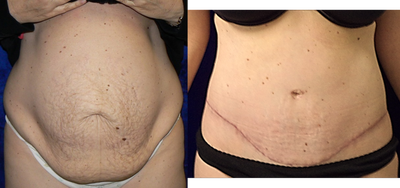 Mommy Makeover before and after photo