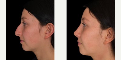 Rhinoplasty before and after photo