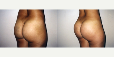 Brazilian Butt Lift before and after photo