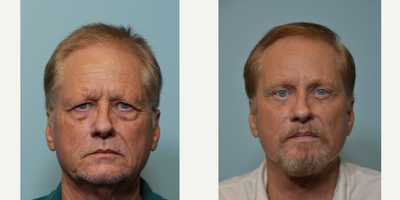 Facelift before and after photo