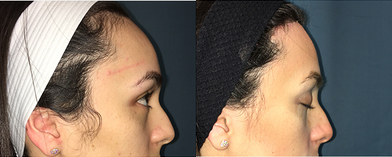 Forehead Reduction before and after photo