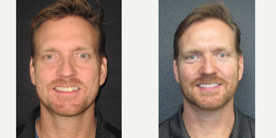 Invisalign before and after photo