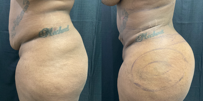 Butt Augmentation before and after photo