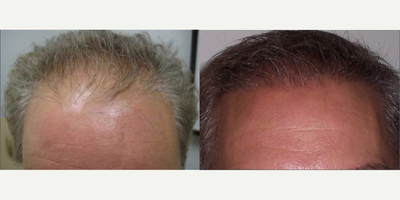NeoGraft before and after photo