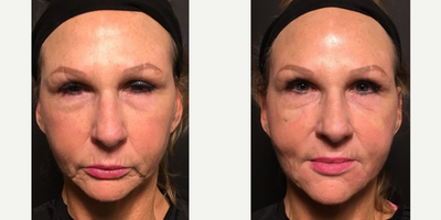 Nonsurgical Facelift before and after photo