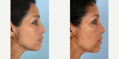 Revision Rhinoplasty before and after photo