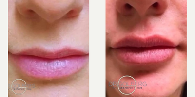 Dermal Fillers before and after photo