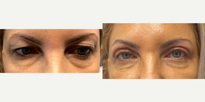 Eyelid Surgery before and after photo