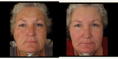 Halo Laser before and after photo