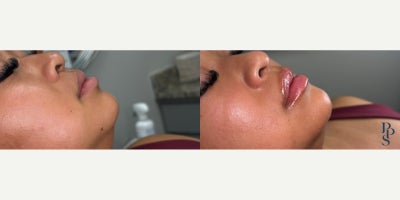 Lip Fillers before and after photo