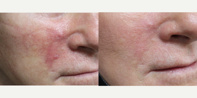 Pulsed Dye Laser before and after photo