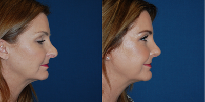 Revision Rhinoplasty before and after photo