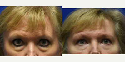 Eyelid Surgery before and after photo