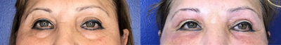 Infini RF before and after photo