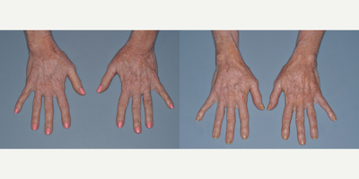 Radiesse before and after photo