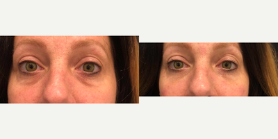 Restylane before and after photo