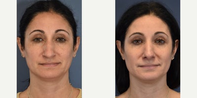 Rhinoplasty before and after photo