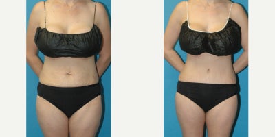 Tummy Tuck before and after photo