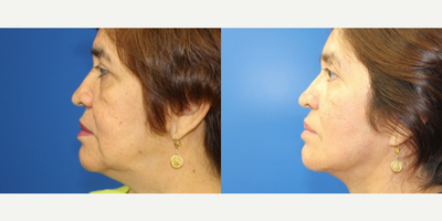 Facelift before and after photo