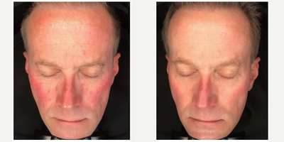 IPL before and after photo