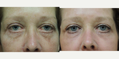 Laser Resurfacing before and after photo