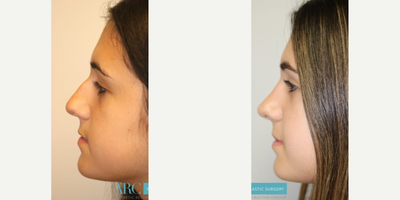 Rhinoplasty before and after photo