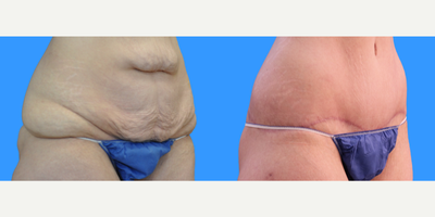 Tummy Tuck before and after photo