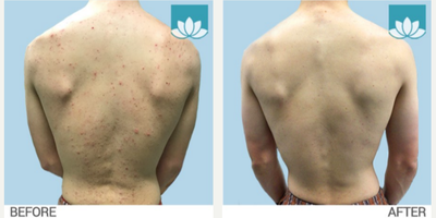 Accutane before and after photo