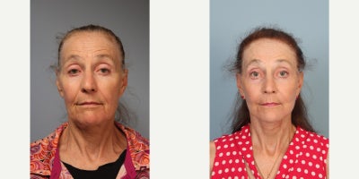 Facelift before and after photo