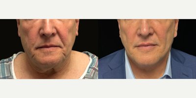 Facelift before and after photo
