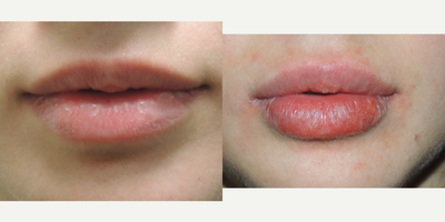 Juvederm before and after photo