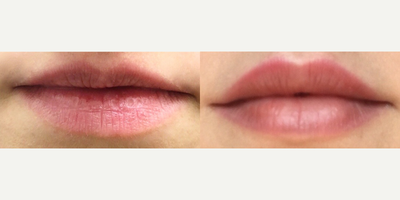 Lip Fillers before and after photo