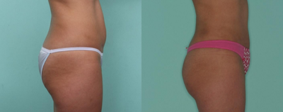 Tummy Tuck before and after photo