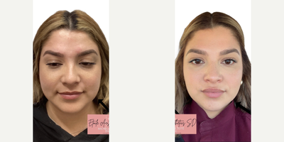 Botox before and after photo