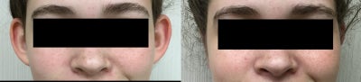 Ear Surgery before and after photo